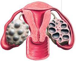 10 cách xử lý khi bị kích buồng trứng do hút trứng làm IVF